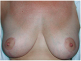Patient # 18011 After Photo # 2